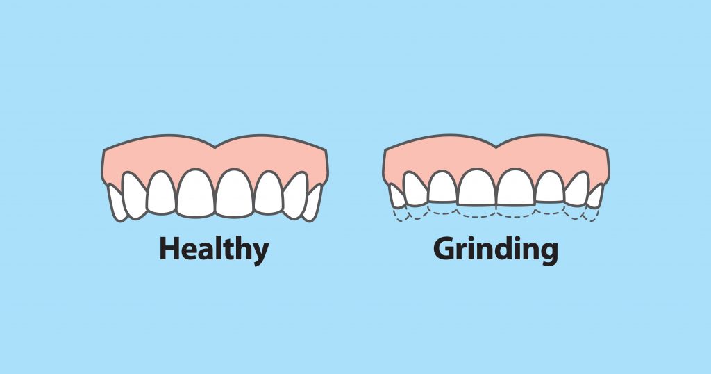 Grinding Teeth Syptoms Solutions 01